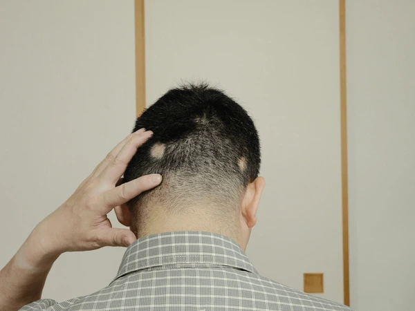 alopecia-areata.-hombe-ensenando-la-parte-de-atras-de-la-cabeza-con-calvas-en-la-cabeza