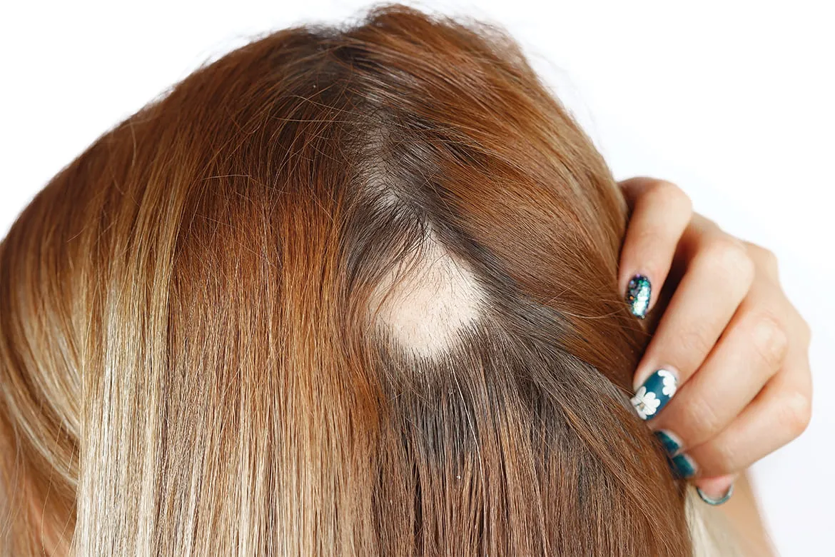 alopecia areata. mujer enseñando calva en el cuero cabelludo