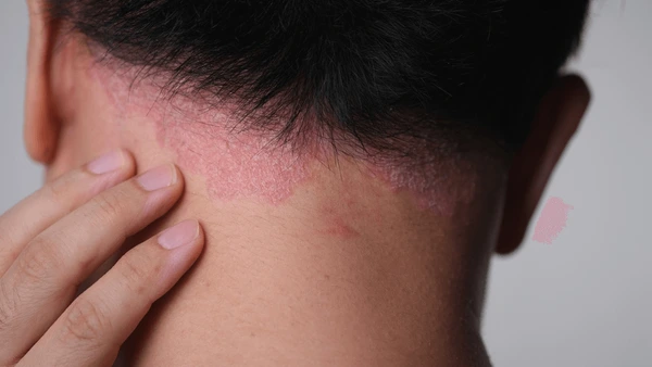 cuero cabelludo irritado. hombre ense帽ando la parte de atras de la cabeza irritada.