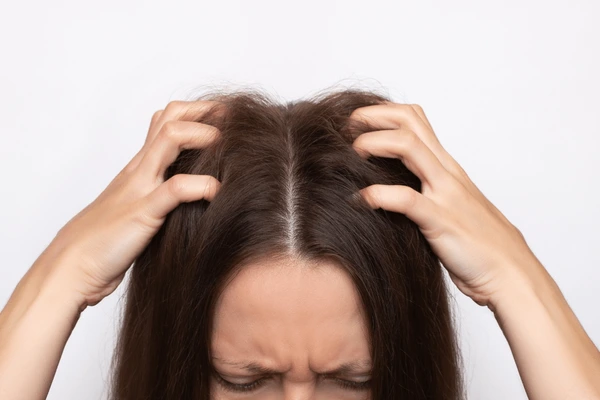 cuero cabelludo irritado. mujer rascandose la cabeza con fuerza